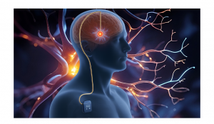 Stimolazione cerebrale profonda: all’ARNAS G. Brotzu i primi impianti in Sardegna della nuova tecnologia direzionale